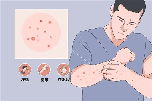 猴痘病毒 猴痘病毒